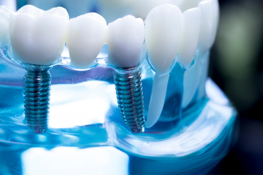 Como funciona o implante dentário?