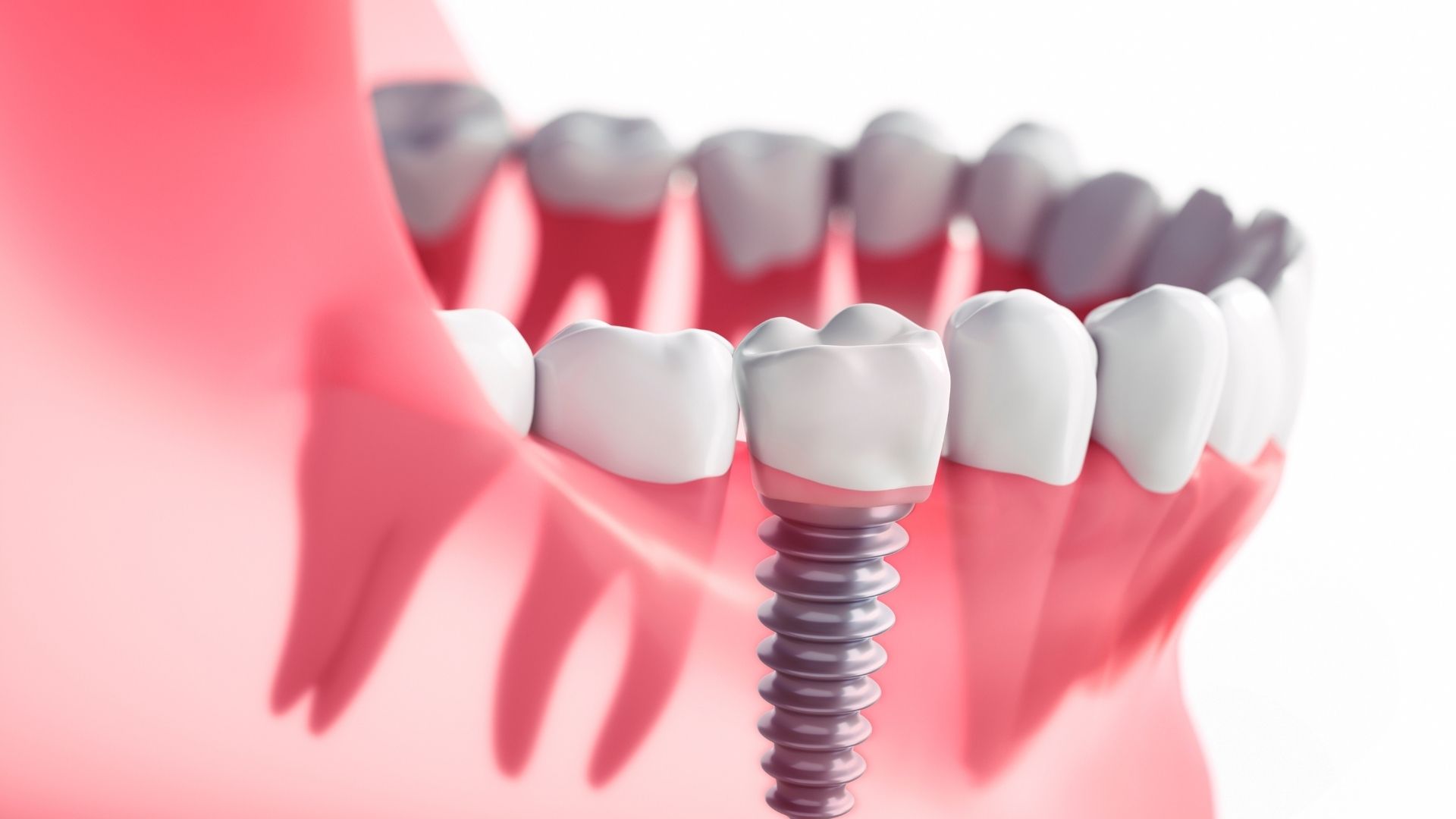 As principais vantagens de fazer um implante dentário