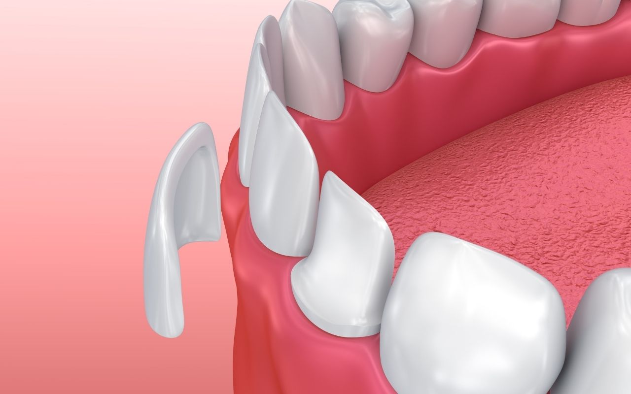 Faceta nos dentes: Conheça os benefícios