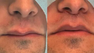 Lip Lift e técnicas avançadas de rejuvenescimento facial sem volume